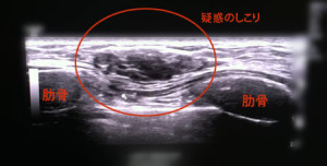 針生検biopsyやりました