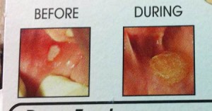 口内炎の治る過程