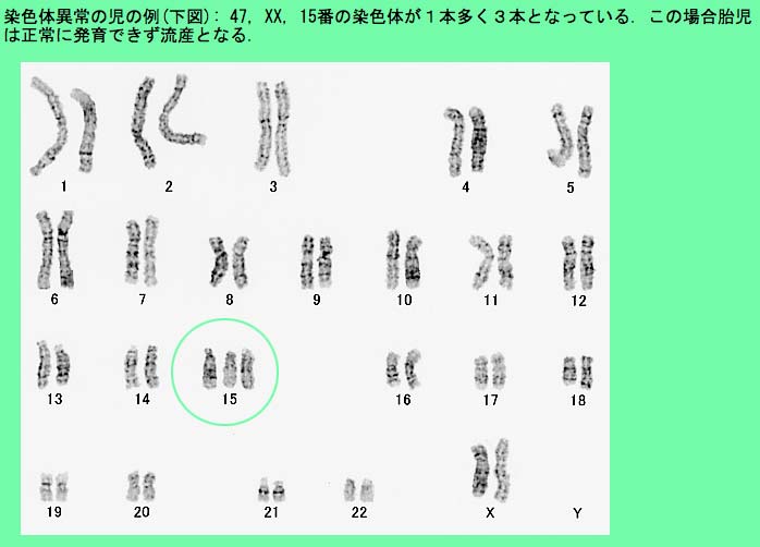 about-trisomy15-2