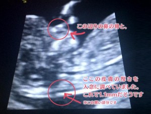 胎児ドックとNT検査の超音波（エコー）写真