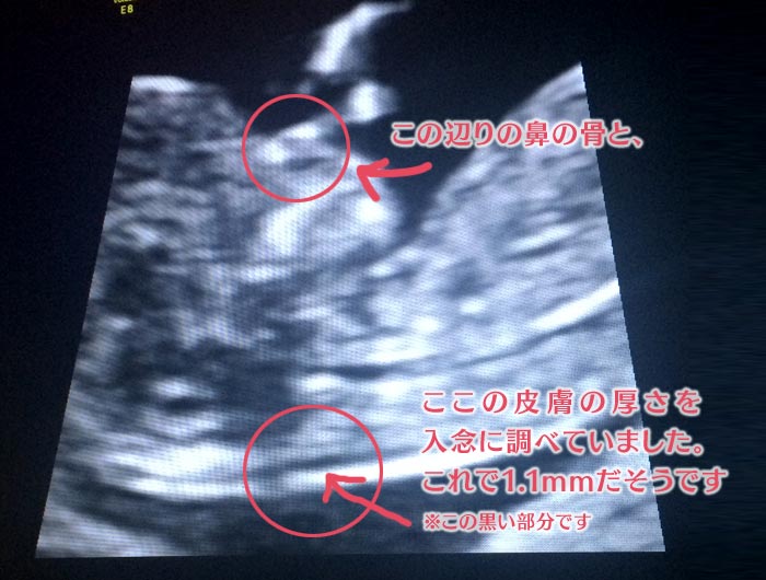 胎児ドックとNT検査の超音波（エコー）写真