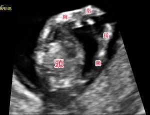 胎児ドックとNT検査の超音波（エコー）写真
