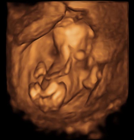 赤ちゃんの3Dエコー画像