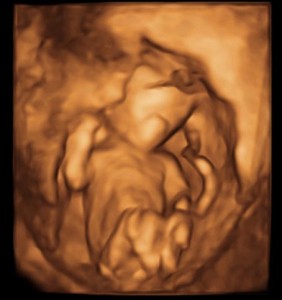 赤ちゃんの3Dエコー画像（12週）