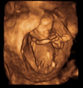赤ちゃんの3Dエコー画像（12週）