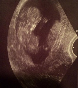 妊娠10週目の超音波（エコー）画像