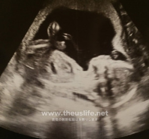 妊娠18週のエコー写真