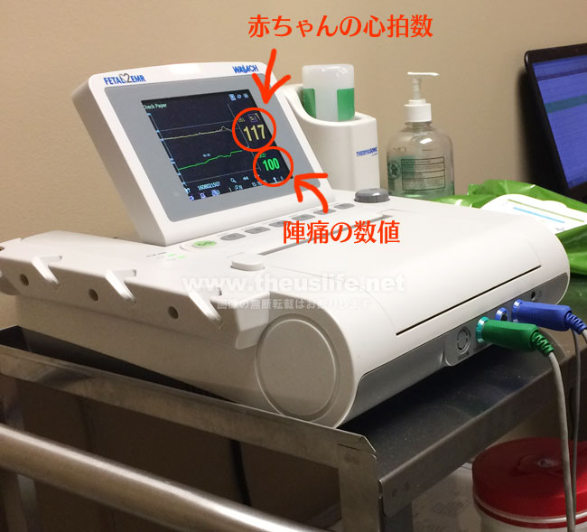 妊娠37週+6dのNST（ノンストレステスト）